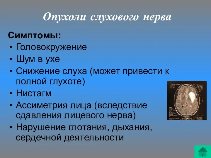 Опухоли слухового нерва Симптомы: Головокружение Шум в ухе Снижение слуха (может