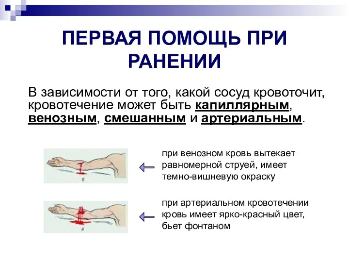 ПЕРВАЯ ПОМОЩЬ ПРИ РАНЕНИИ В зависимости от того, какой сосуд кровоточит,