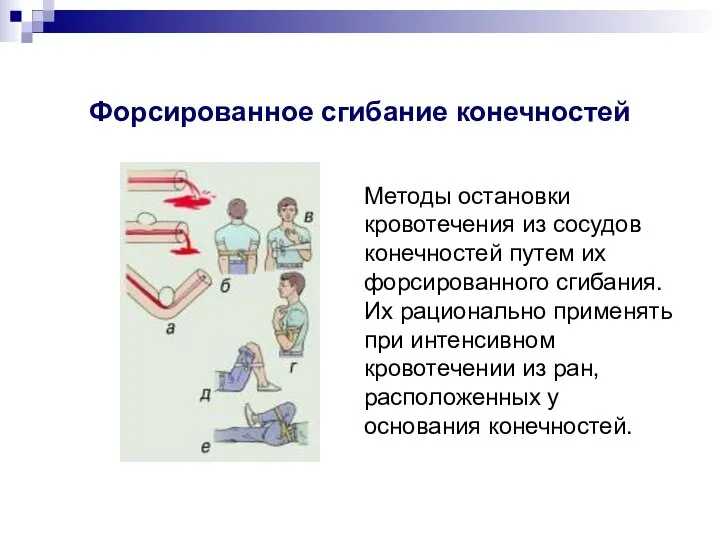 Форсированное сгибание конечностей Методы остановки кровотечения из сосудов конечностей путем их