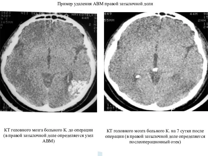 Пример удаления АВМ правой затылочной доли КТ головного мозга больного К.