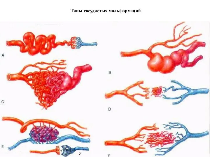 Типы сосудистых мальформаций.