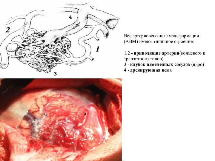 Все артериовенозные мальформации (АВМ) имеют типичное строение: 1,2 - приводящие артерии(концевого