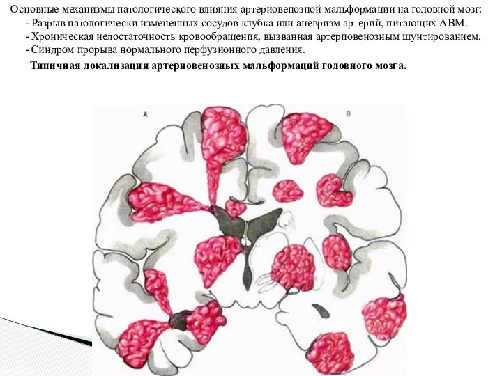 Основные механизмы патологического влияния артериовенозной мальформации на головной мозг: - Разрыв