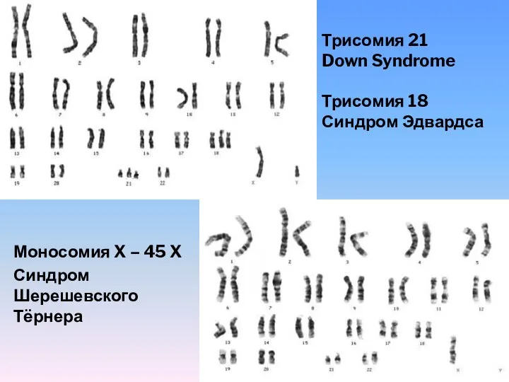 Трисомия 21 Down Syndrome Трисомия 18 Синдром Эдвардса Моносомия X – 45 X Синдром Шерешевского Тёрнера