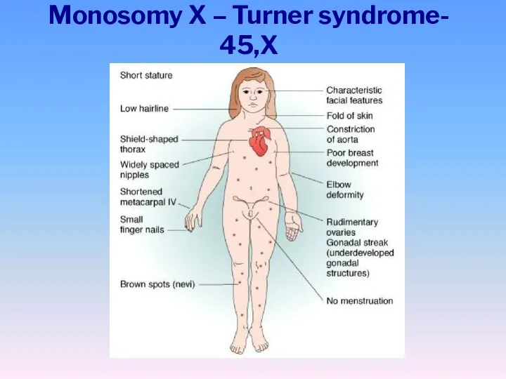 Monosomy X – Turner syndrome- 45,X