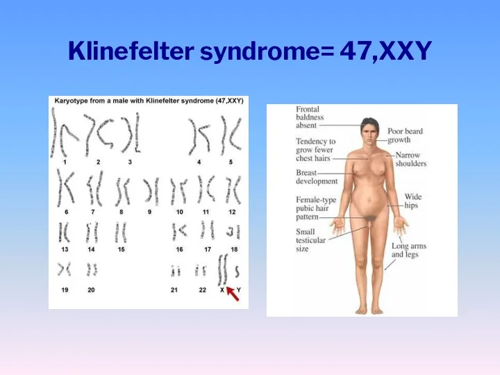 Klinefelter syndrome= 47,XXY