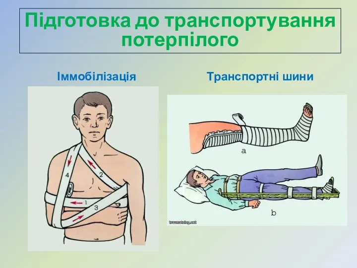 Іммобілізація Транспортні шини Підготовка до транспортування потерпілого