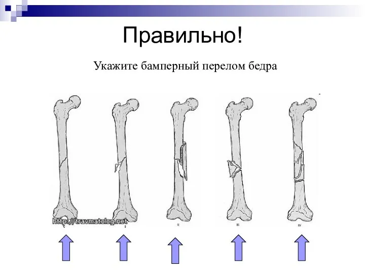 Правильно! Укажите бамперный перелом бедра