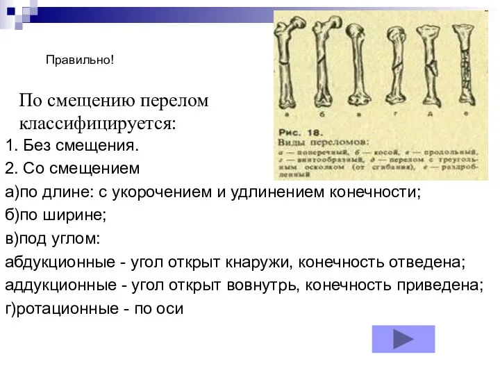 По смещению перелом классифицируется: 1. Без смещения. 2. Со смещением а)по