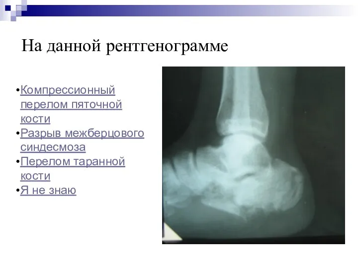 На данной рентгенограмме Компрессионный перелом пяточной кости Разрыв межберцового синдесмоза Перелом таранной кости Я не знаю