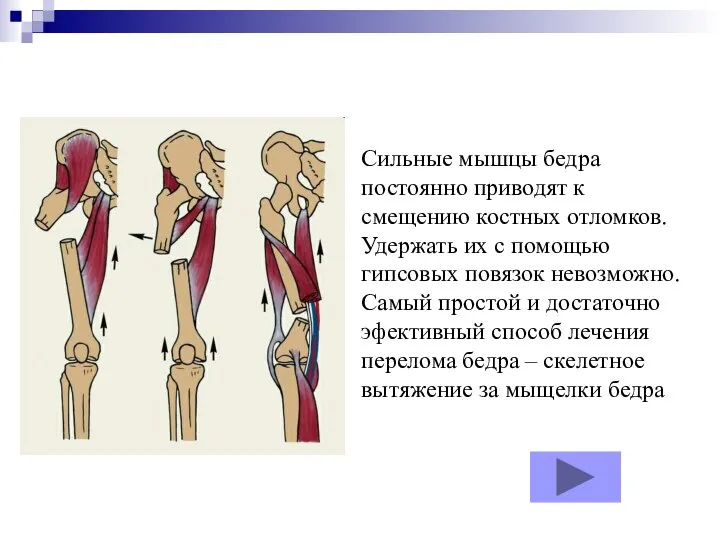 Сильные мышцы бедра постоянно приводят к смещению костных отломков. Удержать их