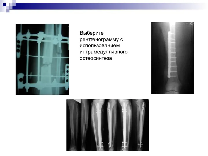 Выберите рентгенограмму с использованием интрамедуллярного остеосинтеза