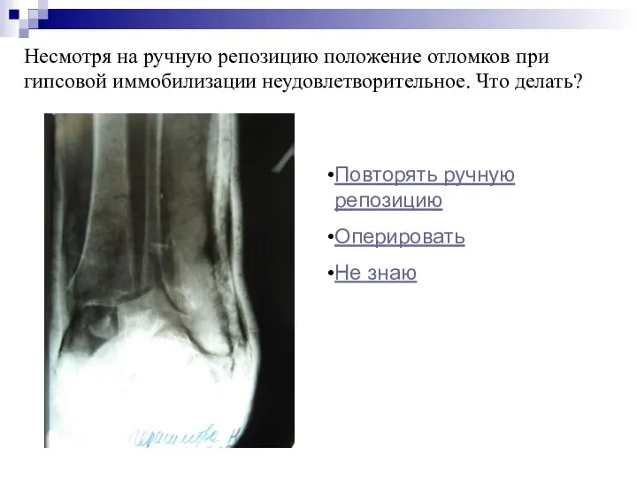 Несмотря на ручную репозицию положение отломков при гипсовой иммобилизации неудовлетворительное. Что