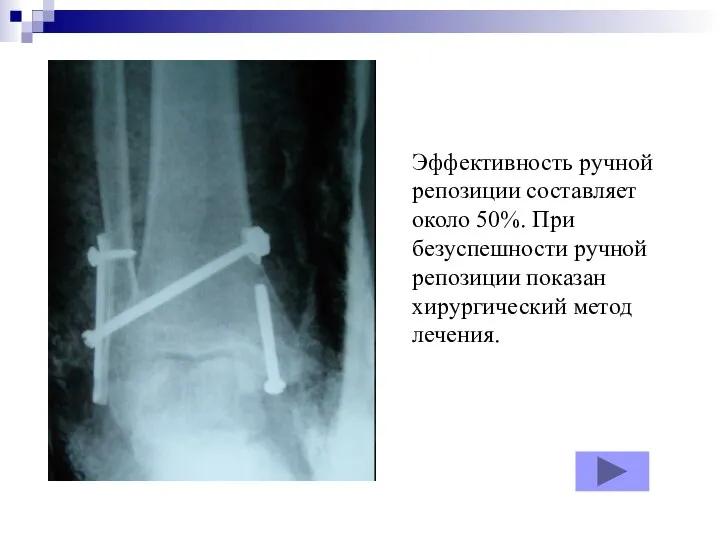 Эффективность ручной репозиции составляет около 50%. При безуспешности ручной репозиции показан хирургический метод лечения.