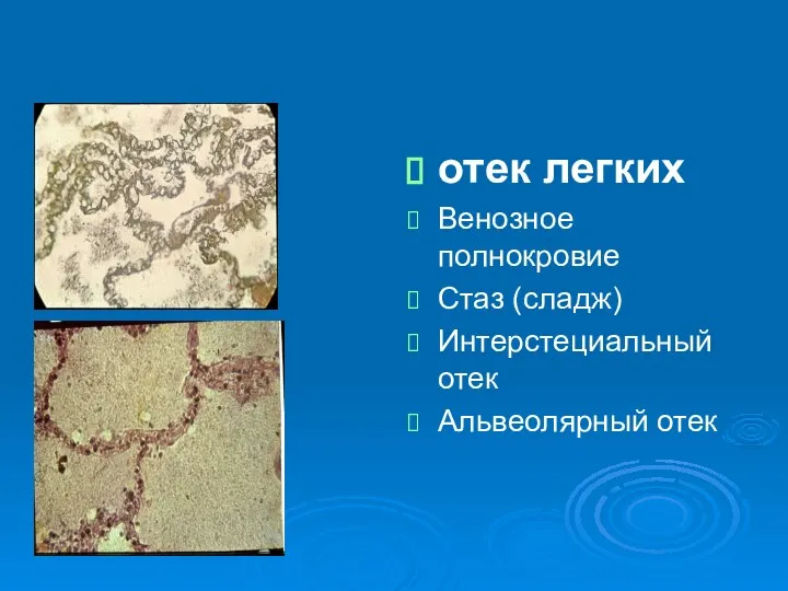 отек легких Венозное полнокровие Стаз (сладж) Интерстециальный отек Альвеолярный отек