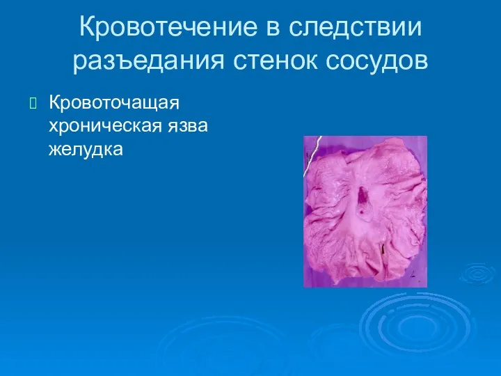 Кровотечение в следствии разъедания стенок сосудов Кровоточащая хроническая язва желудка