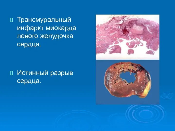 Трансмуральный инфаркт миокарда левого желудочка сердца. Истинный разрыв сердца.