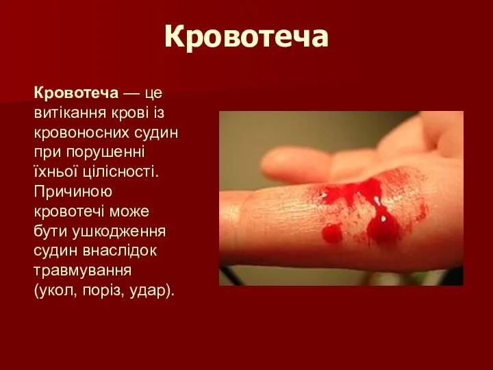 Кровотеча Кровотеча — це витікання крові із кровоносних судин при порушенні