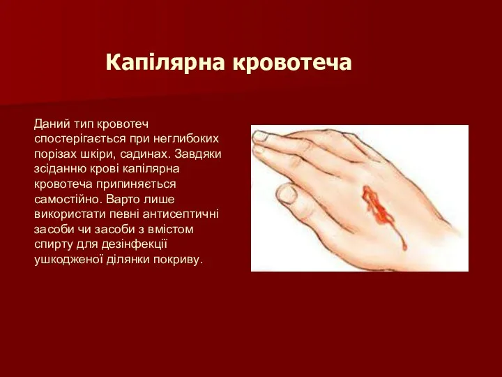 Капілярна кровотеча Даний тип кровотеч спостерігається при неглибоких порізах шкіри, садинах.