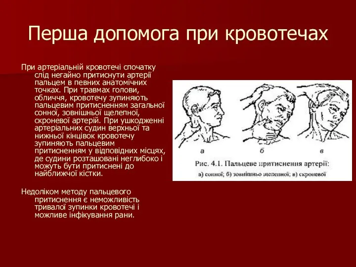 Перша допомога при кровотечах При артеріальній кровотечі спочатку слід негайно притиснути