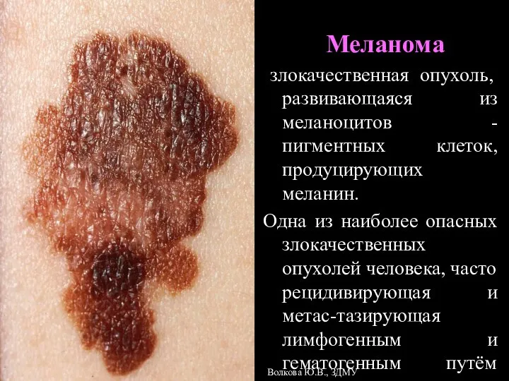 Меланома злокачественная опухоль, развивающаяся из меланоцитов - пигментных клеток, продуцирующих меланин.