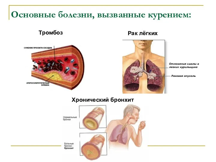 Основные болезни, вызванные курением: Тромбоз Рак лёгких Хронический бронхит