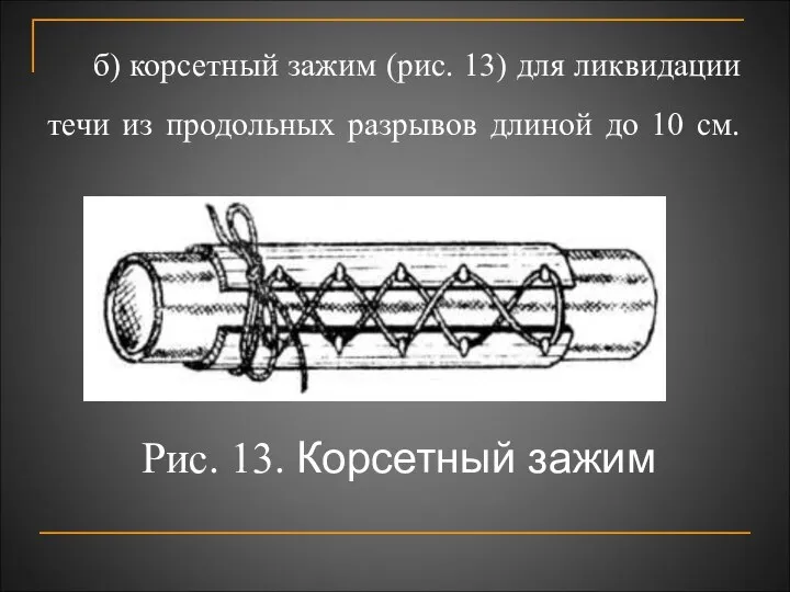 б) корсетный зажим (рис. 13) для ликвидации течи из продольных разрывов