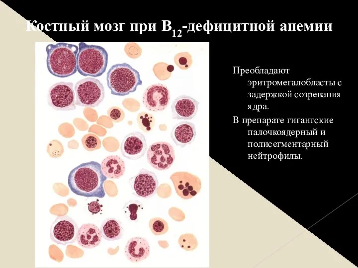 Преобладают эритромегалобласты с задержкой созревания ядра. В препарате гигантские палочкоядерный и