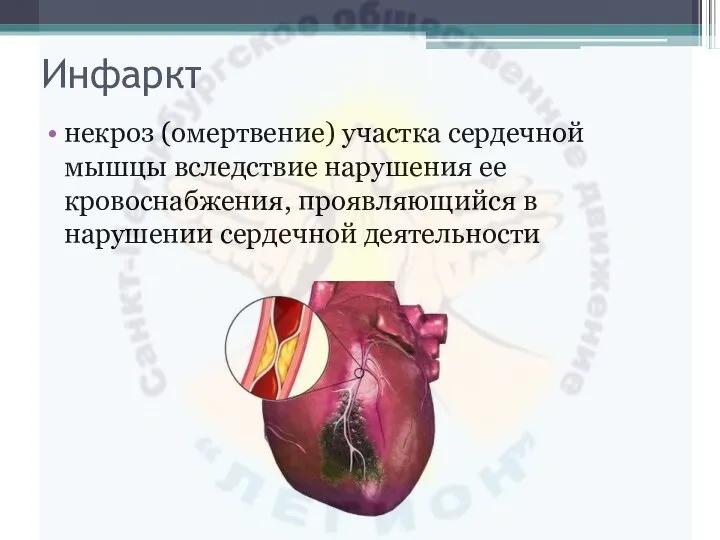Инфаркт некроз (омертвение) участка сердечной мышцы вследствие нарушения ее кровоснабжения, проявляющийся в нарушении сердечной деятельности