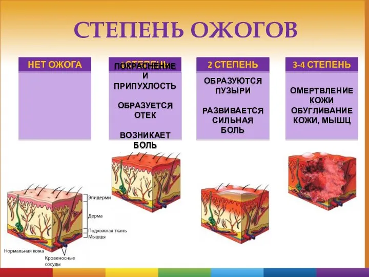 1СТЕПЕНЬ ПОКРАСНЕНИЕ И ПРИПУХЛОСТЬ ОБРАЗУЕТСЯ ОТЕК ВОЗНИКАЕТ БОЛЬ 2 СТЕПЕНЬ ОБРАЗУЮТСЯ