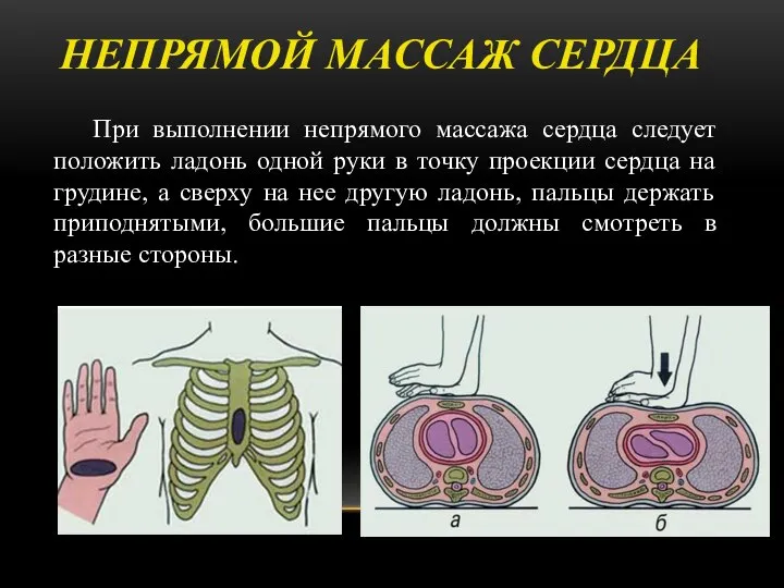 НЕПРЯМОЙ МАССАЖ СЕРДЦА При выполнении непрямого массажа сердца следует положить ладонь