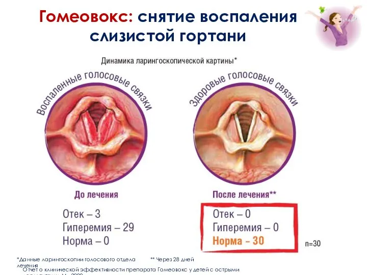 Отчет о клинической эффективности препарата Гомеовокс у детей с острыми ларингитами.