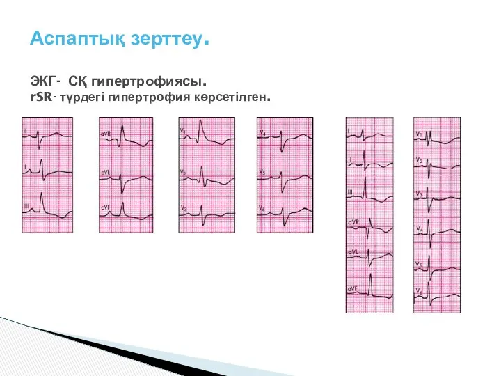 Аспаптық зерттеу. ЭКГ- СҚ гипертрофиясы. rSR- түрдегі гипертрофия көрсетілген.