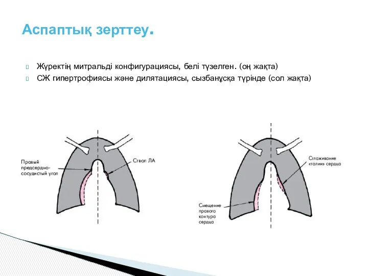 Жүректің митральді конфигурациясы, белі түзелген. (оң жақта) СЖ гипертрофиясы және дилятациясы,