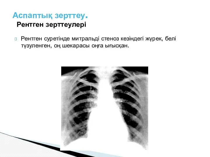 Рентген суретінде митральді стеноз кезіндегі жүрек, белі түзуленген, оң шекарасы оңға ығысқан. Аспаптық зерттеу. Рентген зерттеулері