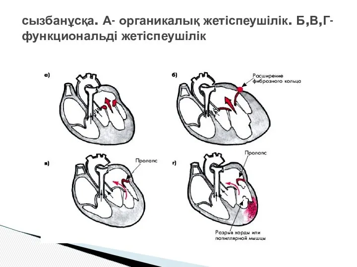 сызбанұсқа. А- органикалық жетіспеушілік. Б,В,Г- функциональді жетіспеушілік