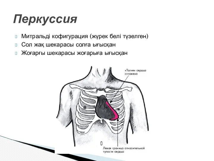 Митральді кофигурация (жүрек белі түзелген) Сол жақ шекарасы солға ығысқан Жоғарғы шекарасы жоғарыға ығысқан Перкуссия