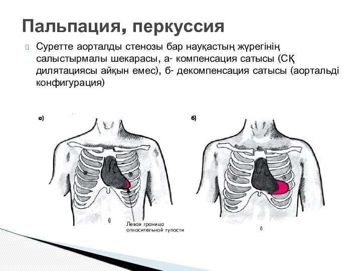 Суретте аорталды стенозы бар науқастың жүрегінің салыстырмалы шекарасы, а- компенсация сатысы