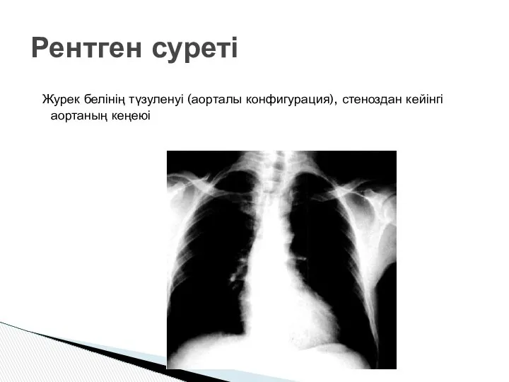 Журек белінің түзуленуі (аорталы конфигурация), стеноздан кейінгі аортаның кеңеюі Рентген суреті