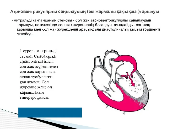 -митральді қақпақшаның стенозы - сол жақ атриовентрикулярлы саңылаудың тарылуы, нәтижесінде сол