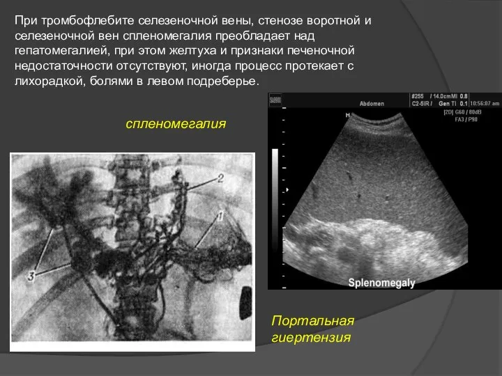 При тромбофлебите селезеночной вены, стенозе воротной и селезеночной вен спленомегалия преобладает