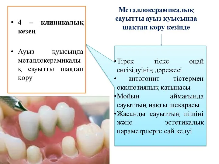 Металлокерамикалық сауытты ауыз қуысында шақтап көру кезінде Тірек тіске оңай енгізілуінің