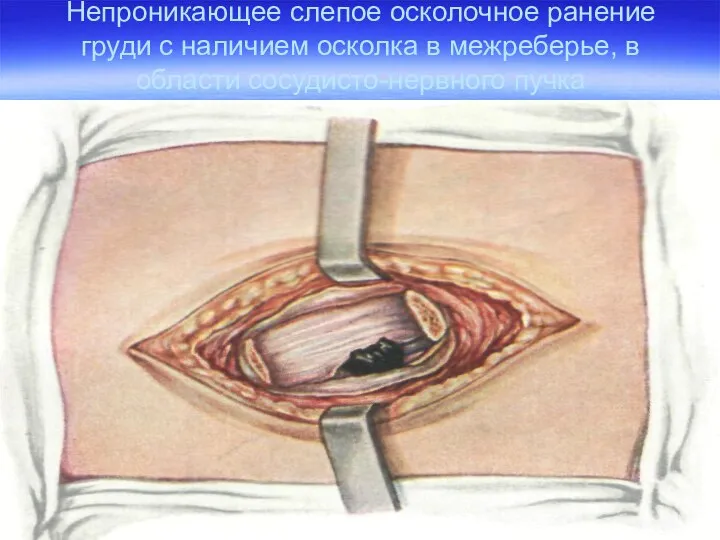 Непроникающее слепое осколочное ранение груди с наличием осколка в межреберье, в области сосудисто-нервного пучка