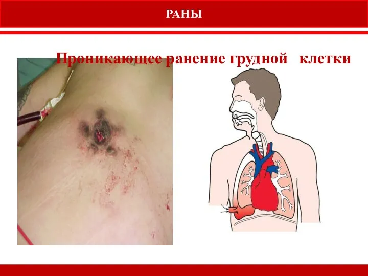 РАНЫ Проникающее ранение грудной клетки