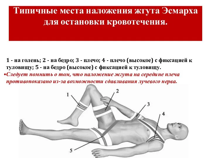 Типичные места наложения жгута Эсмарха для остановки кровотечения. 1 - на