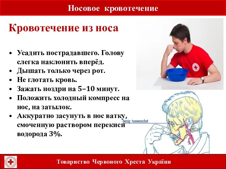 Носовое кровотечение Товариство Червоного Хреста України Усадить пострадавшего. Голову слегка наклонить