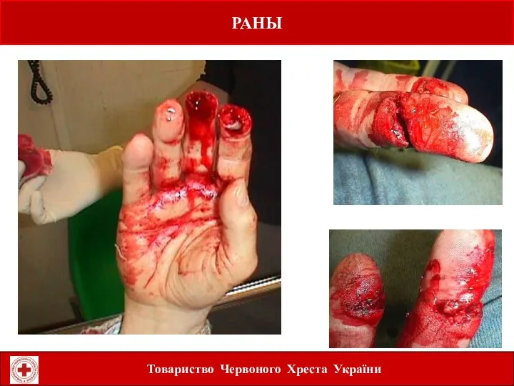 РАНЫ Laceration to fingers Товариство Червоного Хреста України