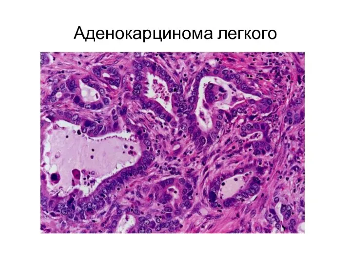 Аденокарцинома легкого