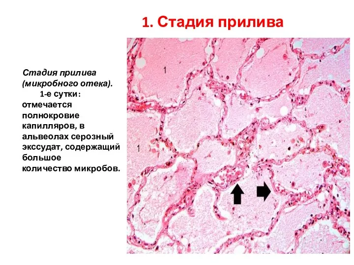 Стадия прилива (микробного отека). 1-е сутки: отмечается полнокровие капилляров, в альвеолах