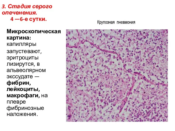 3. Стадия серого опеченения. 4 —6-е сутки. Микроскопическая картина: капилляры запустевают,